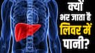 पेट फूलना जैसे होते हैं लिवर में पानी भरने के लक्षण, डॉक्टर बता रहे हैं इसके कारण