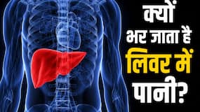 पेट फूलना जैसे होते हैं लिवर में पानी भरने के लक्षण, डॉक्टर बता रहे हैं इसके कारण पेट फूलना जैसे होते हैं लिवर में पानी भरने के लक्षण, डॉक्टर बता रहे हैं इसके कारण