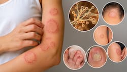 मानसून में तेजी से बढ़ सकता है Ringworm का खतरा, जानें कारण, लक्षण, इलाज और बचाव