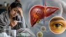 Viral fever or hepatitis? Why yellow eyes, dark urine and weakness shouldn't be ignored