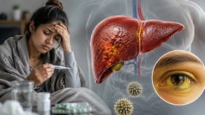 Viral fever or hepatitis? Why yellow eyes, dark urine and weakness shouldn't be ignored