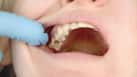 No Drill, No Pain: Liquid Treatment Stops Cavities In Over Half Of Children Teeth