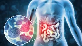 Colon cancer cells can change identity to spread faster, new study reveals