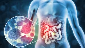 Colon cancer cells can change identity to spread faster, new study reveals