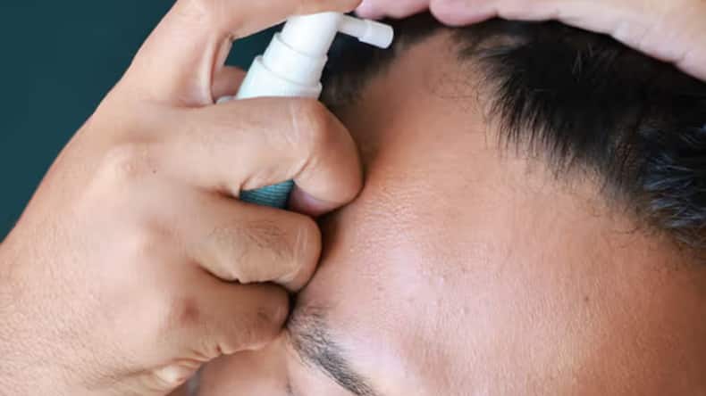 5 alternatives to spironolactone to reverse hair loss