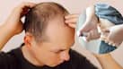 Can GLP-1 weight loss drugs cause hair loss? New study finds a possible link