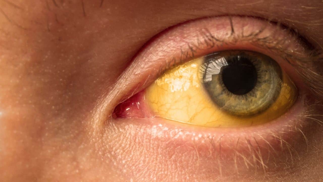 Hepatitis Symptoms