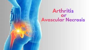 Hip pain that doesn’t go away? It could be avascular necrosis, not arthritis