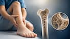Hypophosphatasia explained: The rare genetic condition that leaves bones too weak to harden
