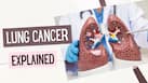 Lung cancer explained: What really happens when cancerous cells begin growing inside the lungs