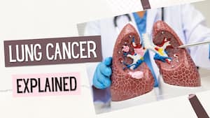 Lung cancer explained: What really happens when cancerous cells begin growing inside the lungs