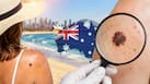 Australia tops melanoma incidence as global cases forecast to reach 263,000 by 2035