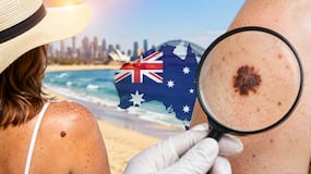 Australia tops melanoma incidence as global cases forecast to reach 263,000 by 2035