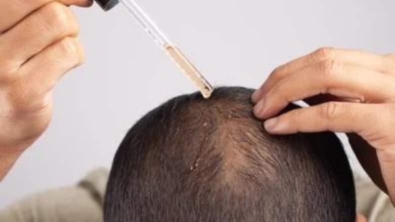 5 alternatives to spironolactone to reverse hair loss