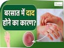 दाद की परेशानी बारिश के मौसम में क्यों होती है ज्यादा।Ringworm in Monsoon