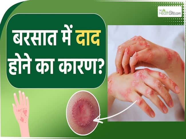दाद की परेशानी बारिश के मौसम में क्यों होती है ज्यादा।Ringworm in Monsoon