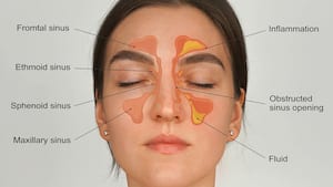 No more stuffy nose: 5 smart ways to prevent sinus issues