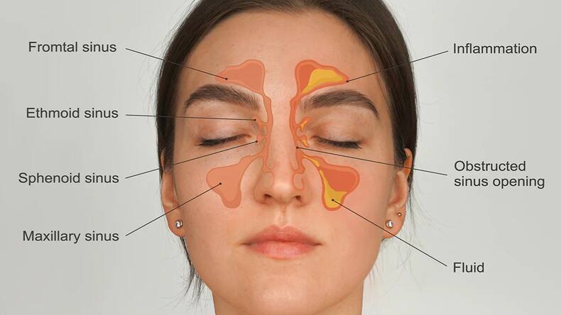 No more stuffy nose: 5 smart ways to prevent sinus issues