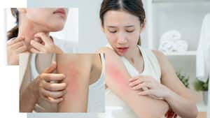 Skin infections during heat: Prevention and care that actually works