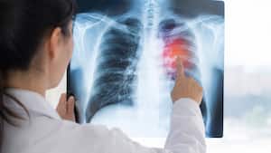 Healthy, young and never smoked? New study reveals why lung cancer still happens