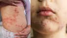 Chickenpox Explainer: माता निकलना क्या होता है? जानें इसके लक्षण, कारण और बचाव के उपाय