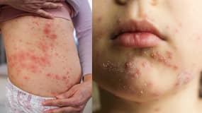 Chickenpox Explainer: माता निकलना क्या होता है? जानें इसके लक्षण, कारण और बचाव के उपाय Chickenpox Explainer: माता निकलना क्या होता है? जानें इसके लक्षण, कारण और बचाव के उपाय
