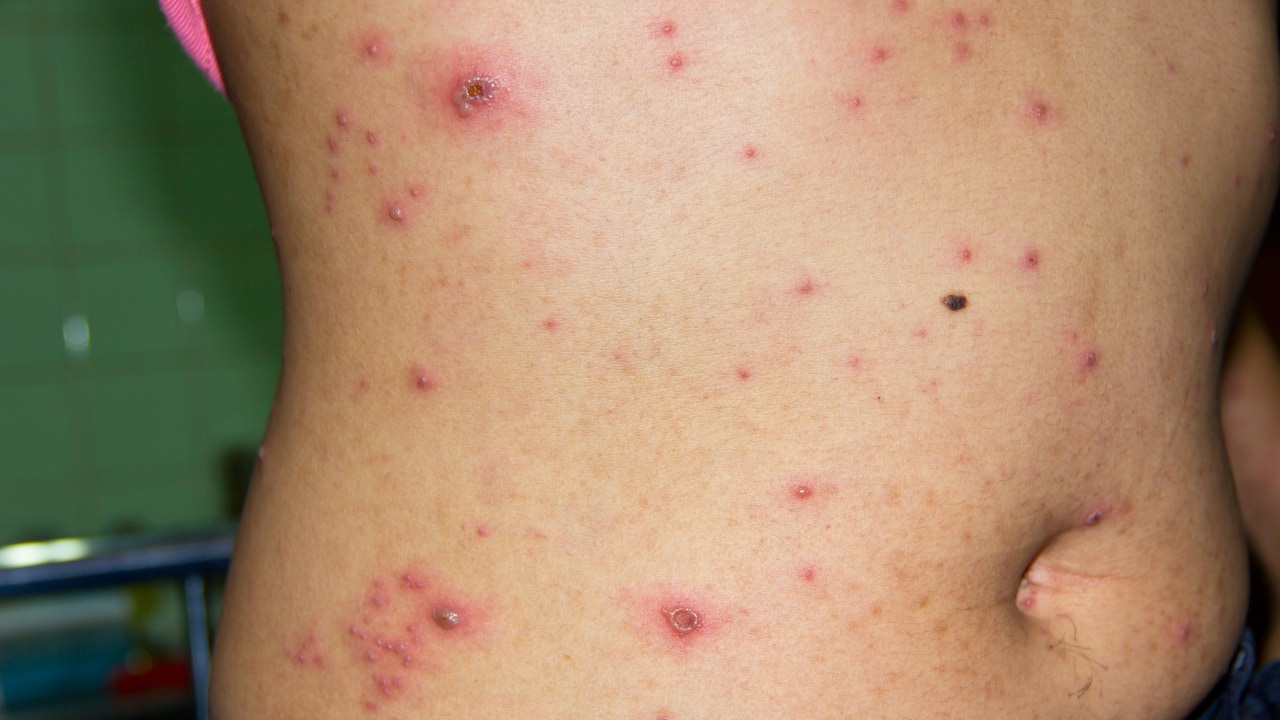chickenpox