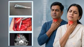दो मरीजों के गले में फंसे मछली के कांटे, डॉक्टरों ने सफलतापूर्वक निकाले