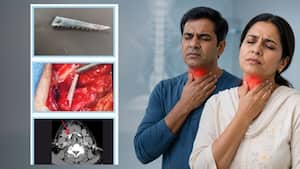 दो मरीजों के गले में फंसे मछली के कांटे, डॉक्टरों ने सफलतापूर्वक निकाले