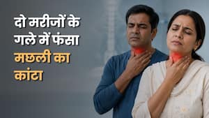 दो मरीजों के गले में फंसे मछली के कांटे, डॉक्टरों ने सफलतापूर्वक निकाले