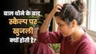 हेड वाश करने के बाद भी स्कैल्प पर खुजली होने का क्या कारण है? एक्सपर्ट से जानें