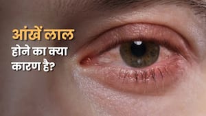 आंखों का सफेद हिस्सा लाल क्यों हो जाता है? जानें इसके कारण और कब डॉक्टर से मिलना चाहिए