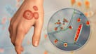 मानसून में तेजी से बढ़ सकता है Ringworm का खतरा, जानें कारण, लक्षण, इलाज और बचाव