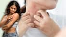 स्किन इंफेक्शन क्या है? जानें कैसे किया जाता है इसका इलाज