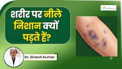 बिना चोट के शरीर पर नीले निशान क्यों पड़ते हैं? डॉक्टर बता रहे हैं इस स्थिति में क्या करें?