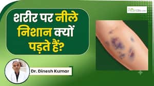 बिना चोट के शरीर पर नीले निशान क्यों पड़ते हैं? डॉक्टर बता रहे हैं इस स्थिति में क्या करें?