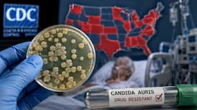 CDC warns drug-resistant candida auris superbug is spreading across 23 states: Who is most at risk?