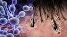 Candida auris outbreak: How this deadly fungus hides in hair follicles to evade skin defences