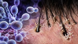 Candida auris outbreak: How this deadly fungus hides in hair follicles to evade skin defences