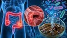 From inflammation to intestinal complications: New study finds distinct stool metabolites may reflect crohn’s disease severity and location