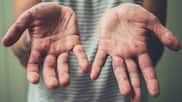Study finds single US measles outbreak can cost millions: How to protect yourself
