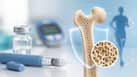 GLP-1 drugs may lower bone fracture risk in people with type 2 diabetes, study finds