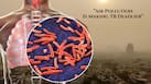 Study links high PM2.5 exposure to increased risk of death among tuberculosis patients during treatment