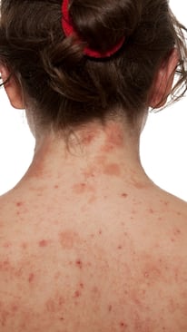 Tips to prevent eczema: 5 simple habits to keep painful flare ups at bay