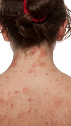 Tips to prevent eczema: 5 simple habits to keep painful flare ups at bay
