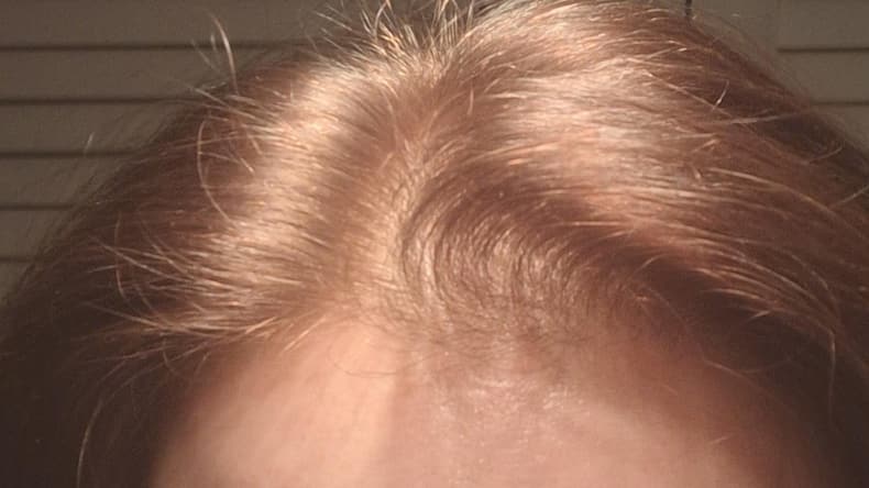 5 signs your hair fall is genetic and not fixable with oils
