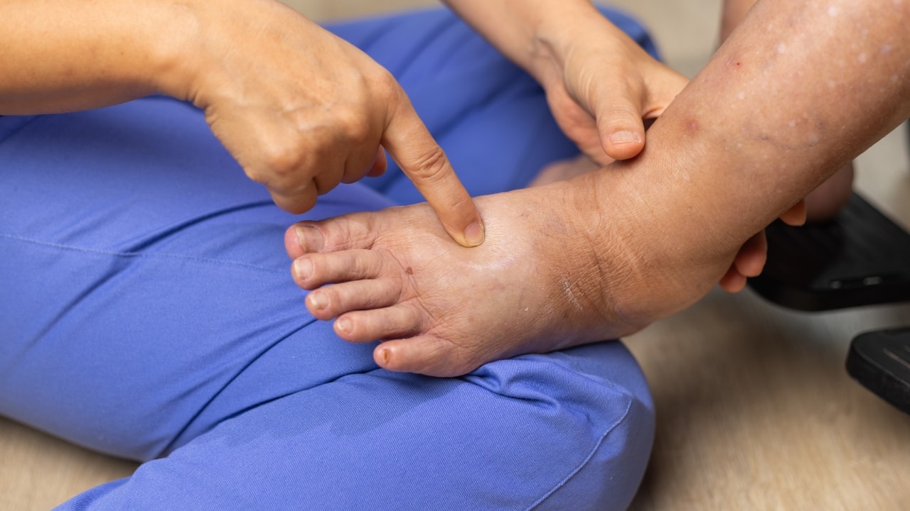 body swelling