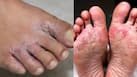 मानसून में पैरों की देखभाल क्यों जरूरी है? अपनाएं ये आसान Foot Care Tips